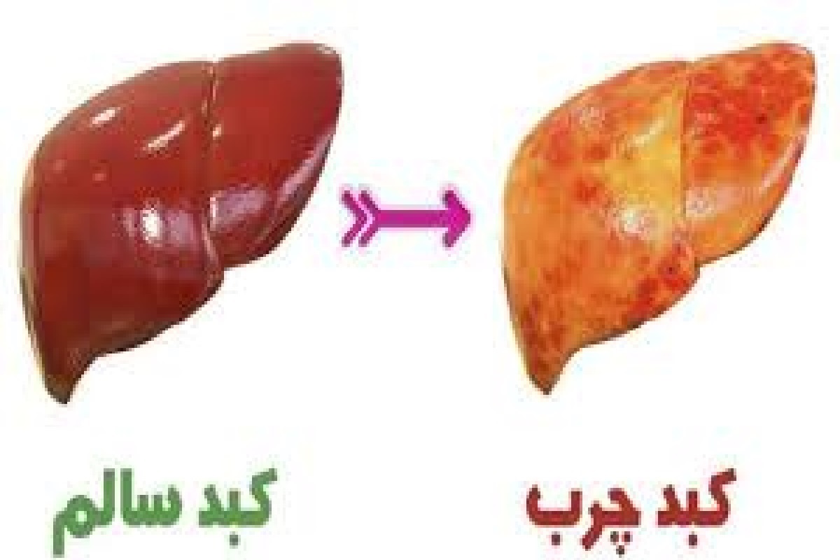 همه چیز راجع به کبد چرب